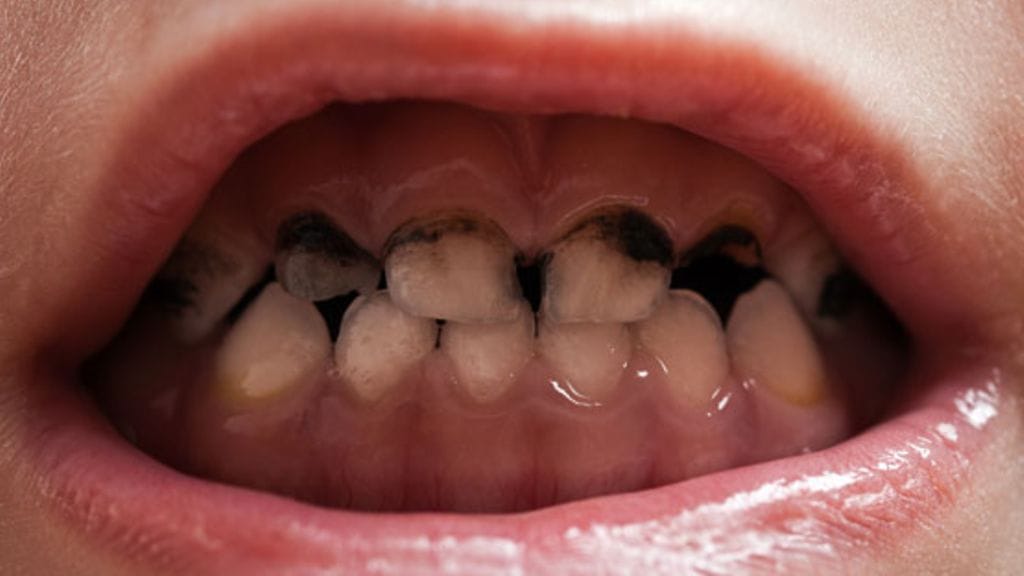 Kokenut hammaslääkäri muistuttaa, että lasten hampaiden suurimmat viholliset ovat sokeripitoinen ruokavalio ja bakteeri nimeltään Streptococcus mutans.