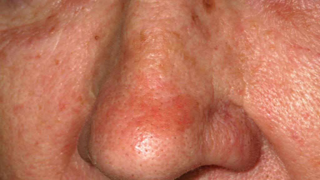 Ihosyöpä voi alkaa viattoman näköisestä aurinkokeratoosista.