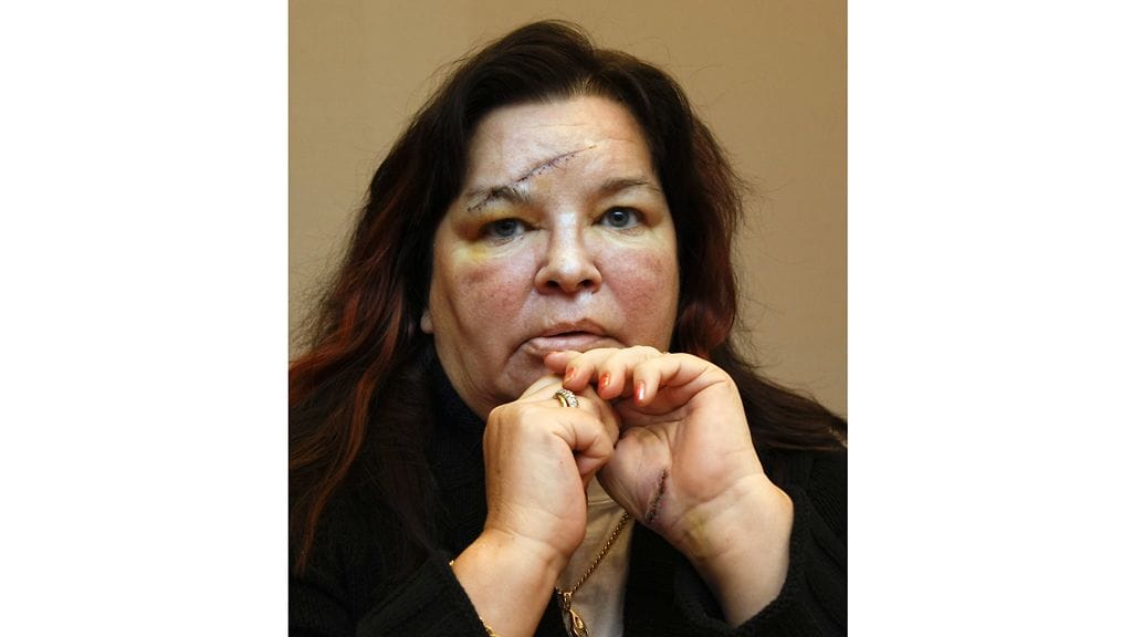 Heti verisen joulutappelun jäljiltä Mervin kasvoissa oli nähtävillä rajut arvet.