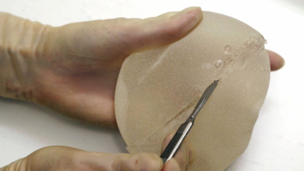 Oikeudenkäynti rintaimplanteista alkoi Ranskassa. Kuvituskuvaa.