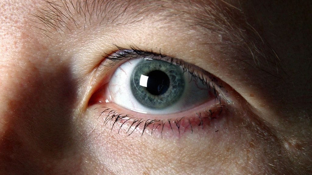 Glaukooma on näkövammaisuutta aiheuttava silmäsairaus.