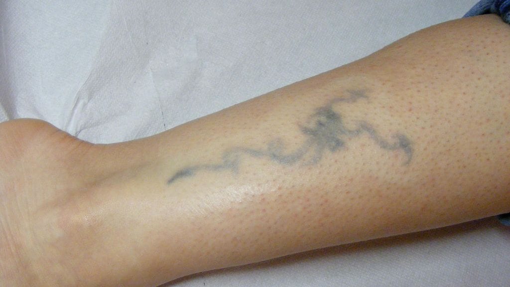 Tatuointia poistetaan laserilla, 2012