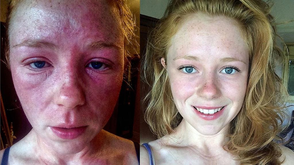 Alice Morgan, 22, ennen ja jälkeen ruokavaliomuutoksen.