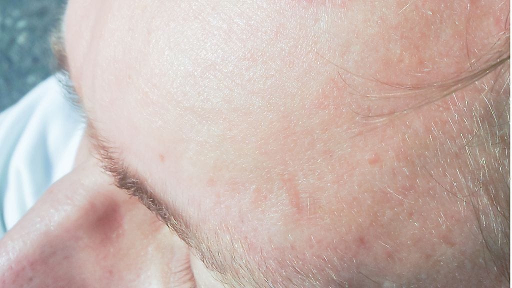 Aivoverenvuodon parasta ennaltaehkäisyä on verenpaineesta huolehtiminen. Nuorenkin kannattaa mittauttaa verenpaineensa silloin tällöin.