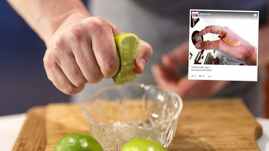 Limen käsittely aiheutti miehen käteen kivuliaan näköisiä oireita.