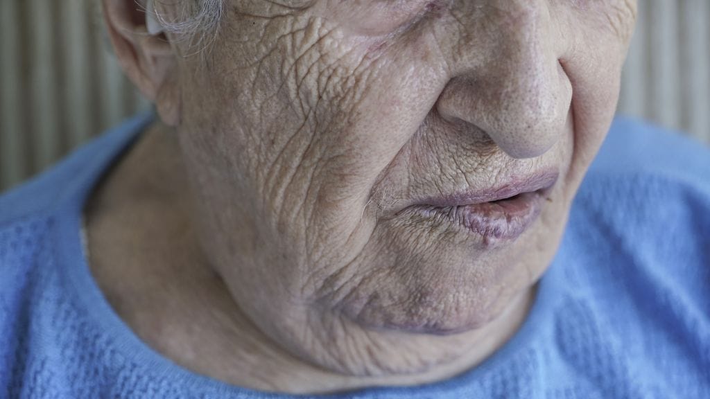 Toisen suupielen roikkuminen on aivoinfarktin oire. Kuvituskuva.