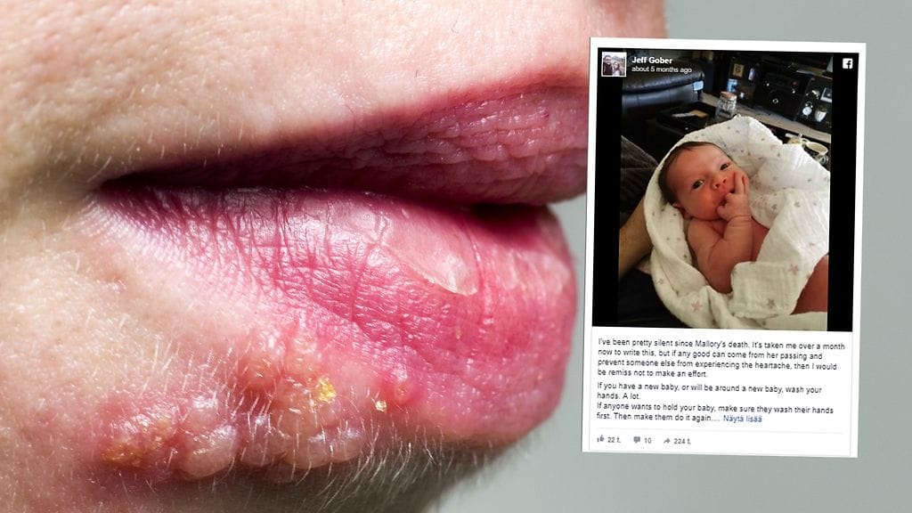 Kolmiviikkoinen vauva kuoli neonataaliherpekseen.