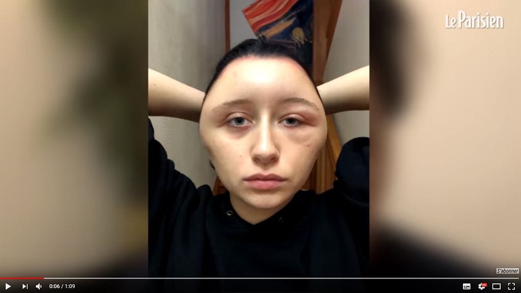 Kuvakaappaus LeParisien-lehden YouTubeen lataamalta videolta Estellen oireista hiustenvärjäyksen jälkeen.