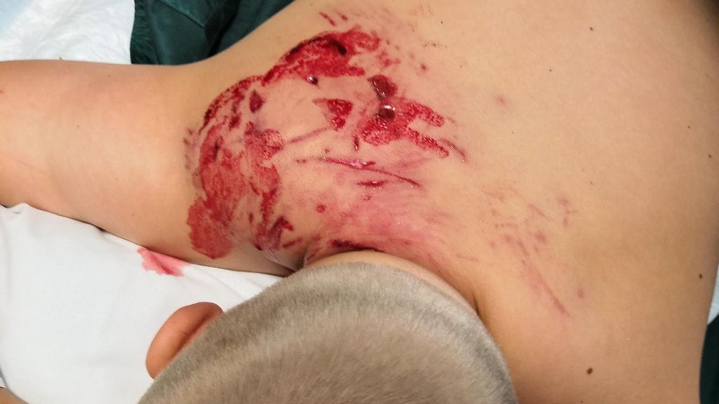 Rajut kuvat: Suuri koira hyökkäsi 10-vuotiaan Janin kimppuun Iittalassa