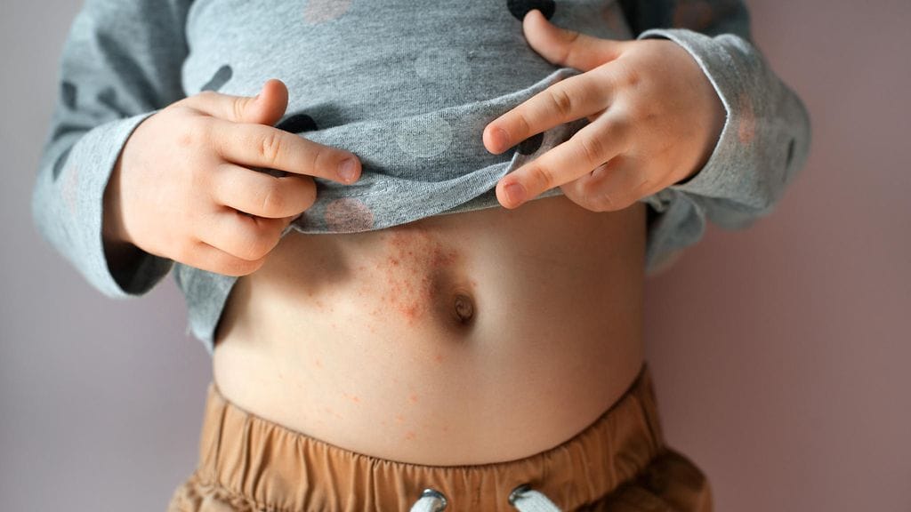 Ihottuma taaperon vatsassa oli oire Kawasakin taudista. Kuvituskuva.