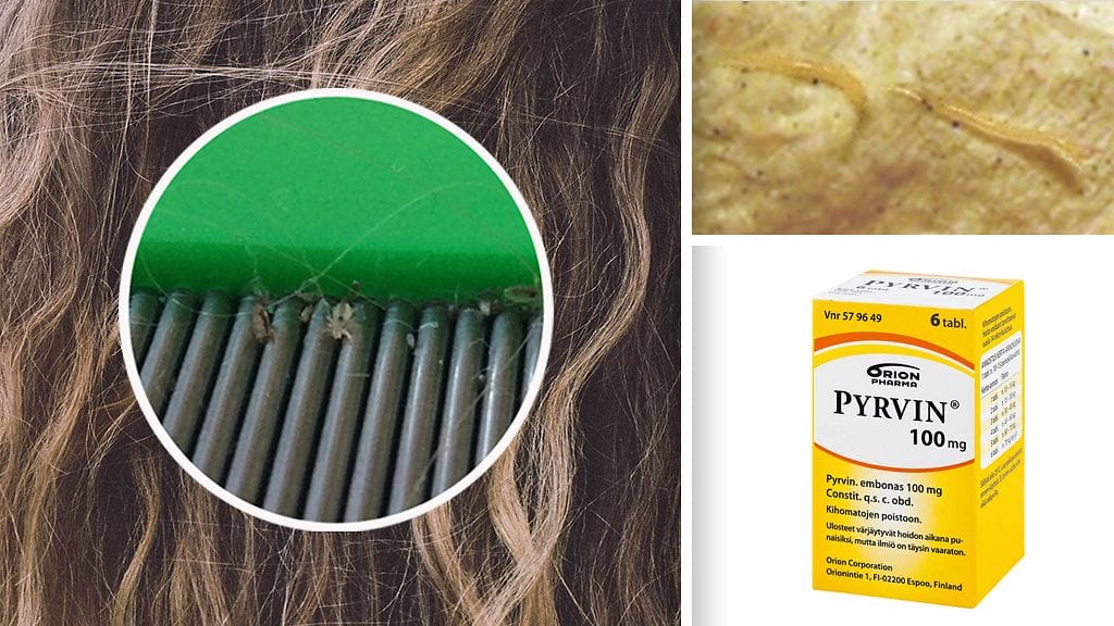 Tältä näyttävät ihmisessä loisivat täit ja kihomadot.