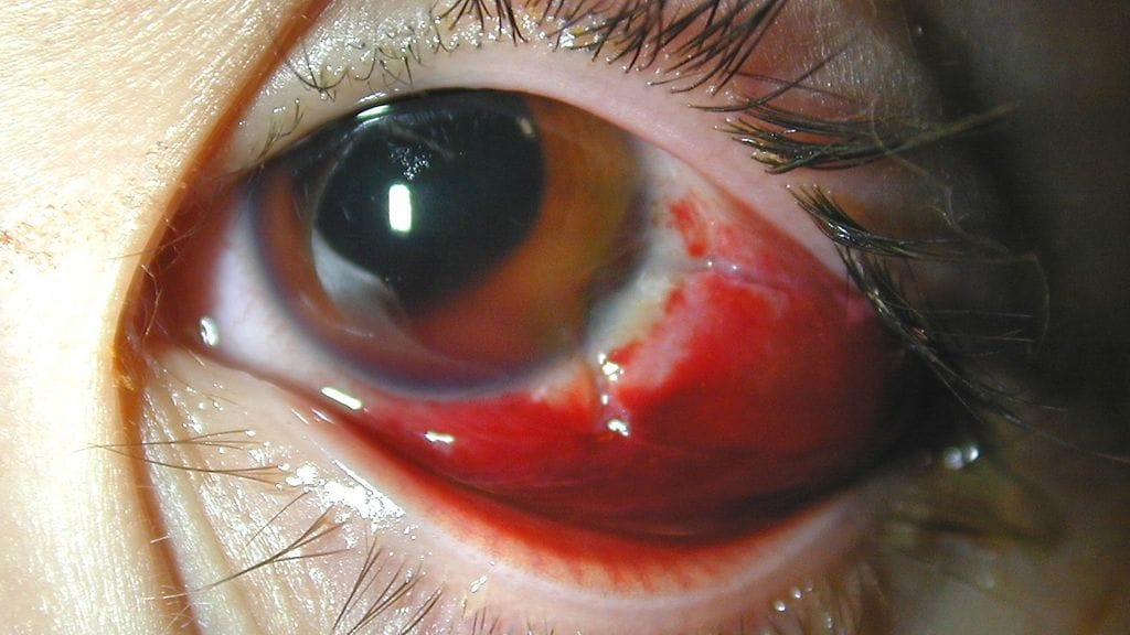 HUS pikkurakettivamma