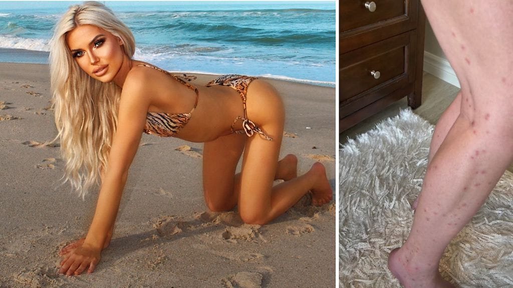 Somevaikuttaja joutui hiekkakärpästen puremaksi.