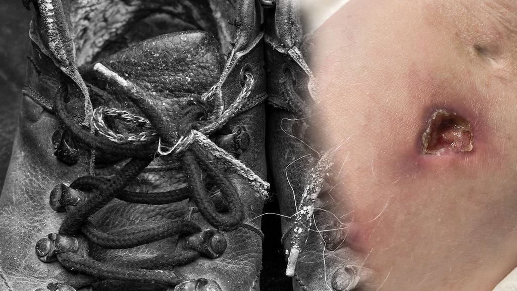 Piikittämisen aiheuttama tulehdus