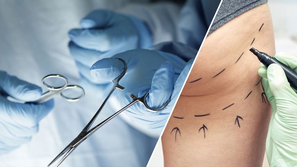 Kauneuskirurgiaan liittyy monenmoisia riskejä.