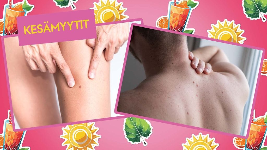 Luomitarkkailussa ei kannata keskittyä vain yhteen ihoalueeseen vaan tarkastaa huolellisesti läpi koko keho.