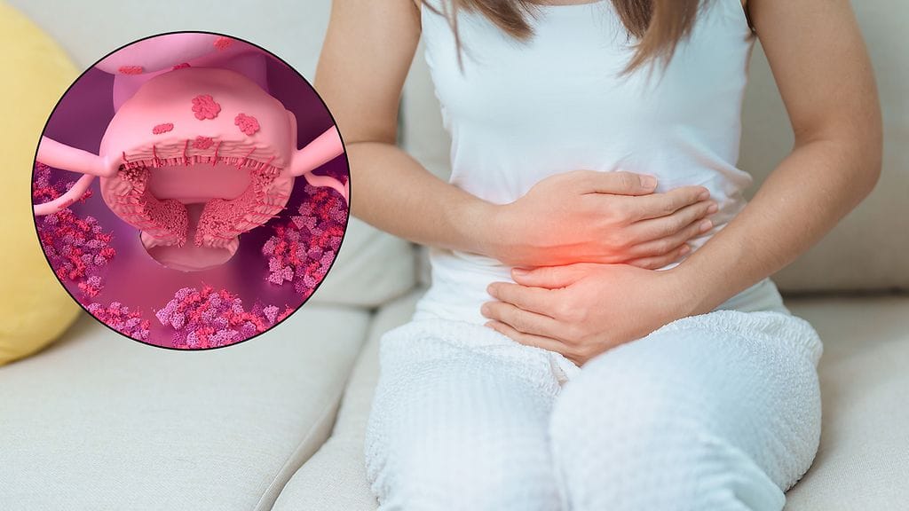 Endometrioosissa kohdun limakalvon kaltaista kudosta esiintyy kohdun ulkopuolella, esimerkiksi munasarjoissa, munanjohtimissa tai vatsakalvon pinnalla.