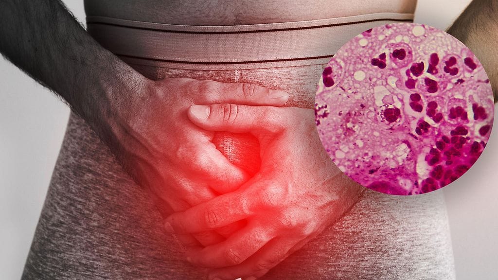 Tippurin tapauksessa ongelmia aiheuttavat antibiooteille resistentit kannat.