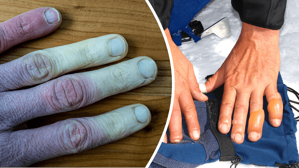 Kaksi esimerkkikuvaa, miltä paleltumat näyttävät.