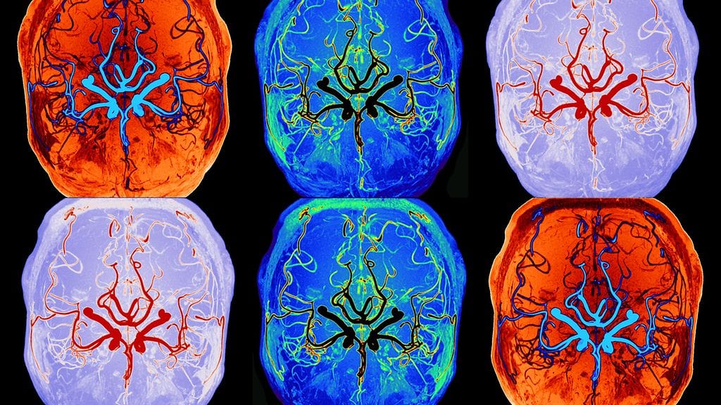 Oulun yliopiston mukaan ultranopea MRI mittaa aivojen nestekiertoa unessa viidessä minuutissa ilman varjoaineita.